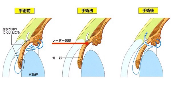 レーザー虹彩切開術( LI )