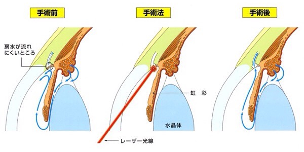 選択的レーザー線維柱帯形成術( SLT )