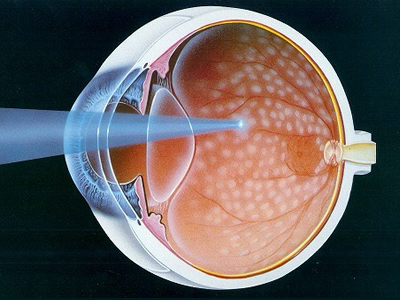 汎網膜光凝固術(PRP)