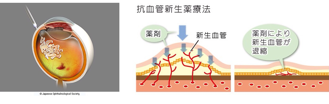 抗VEGF薬